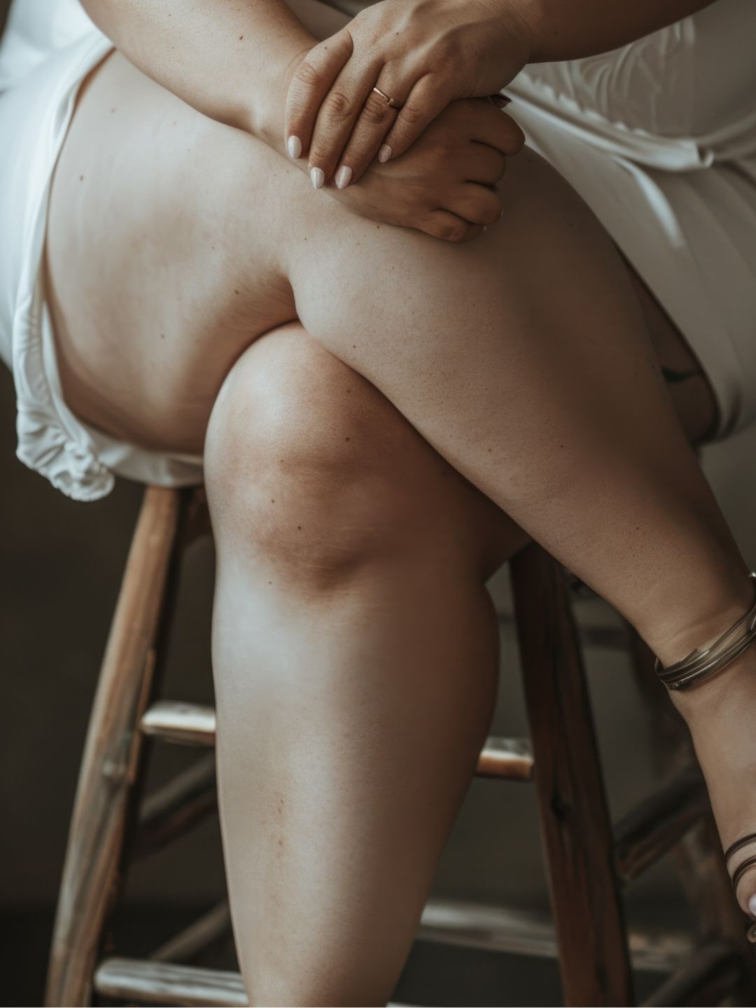 Lipedema, que es, síntomas, grados y tratamientos