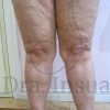 Formación Médica en Lipedema y Linfedema