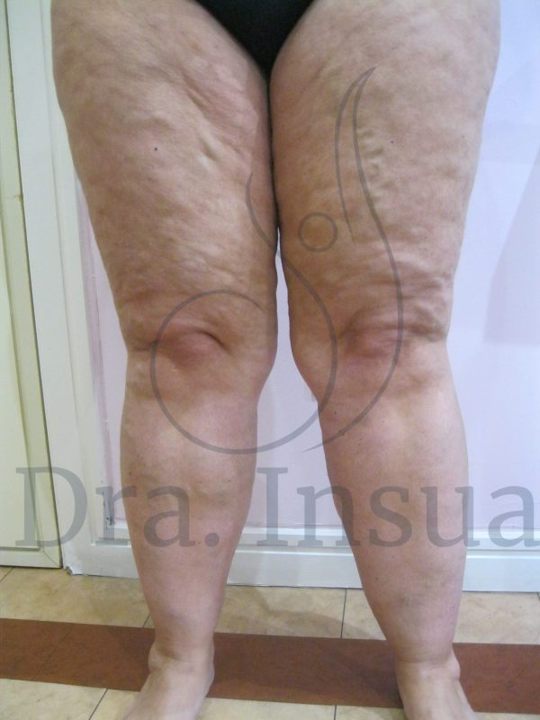 Formación Médica en Lipedema y Linfedema