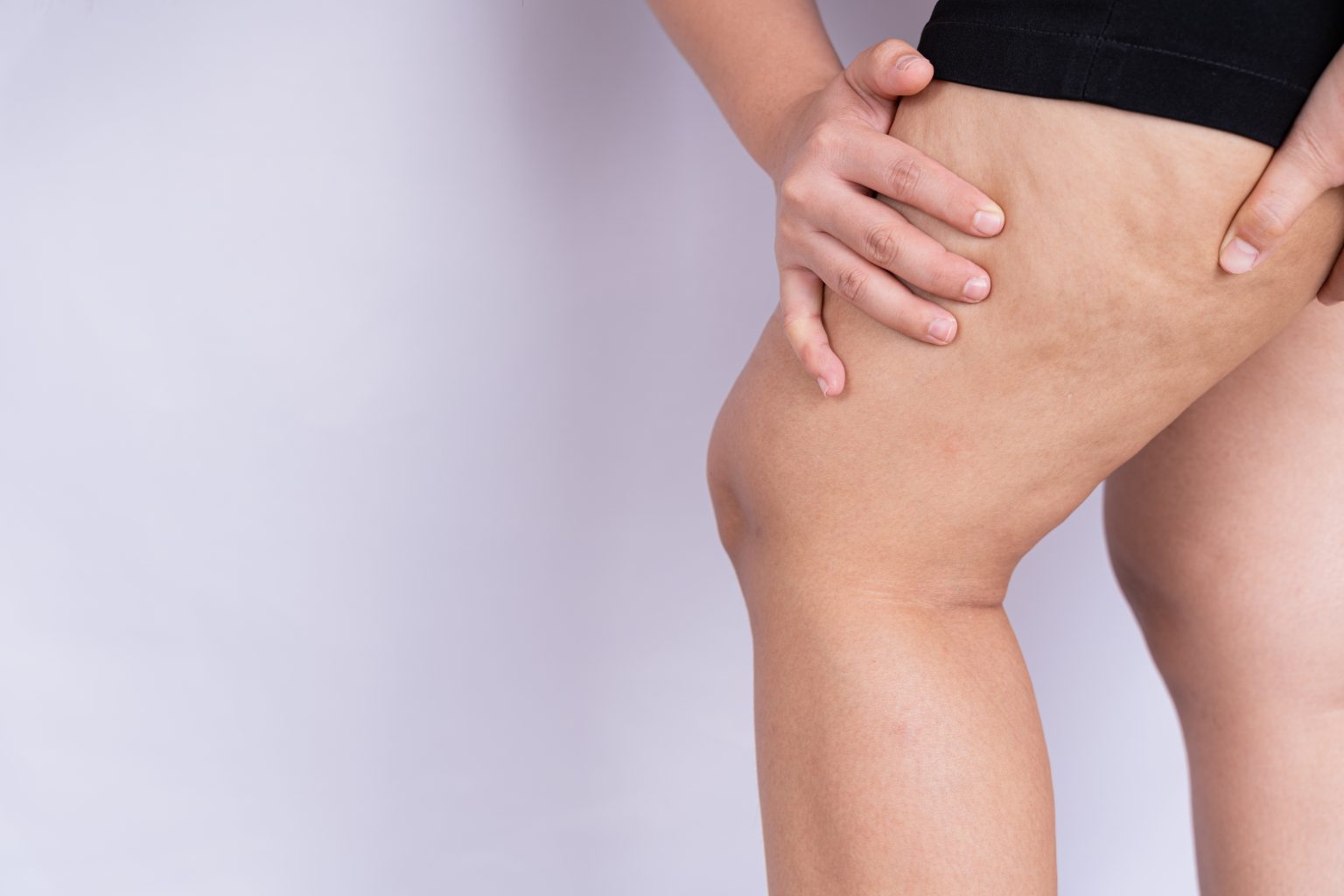 Celulitis o (PEFE): Qué es y Tratamiento - Dra. Emilce Insua