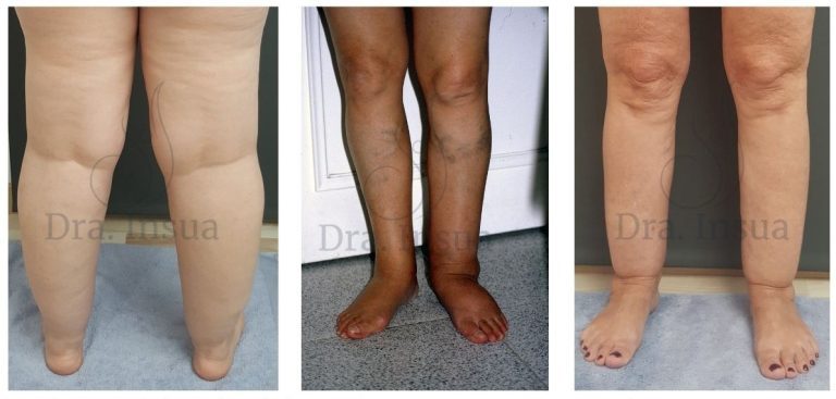 Diferencias entre lipedema, linfedema y obesidad - Dra. Insua