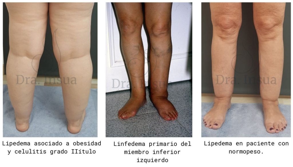 Disferencias entre lipedema, linfedema y obesidad - Dra. Insua