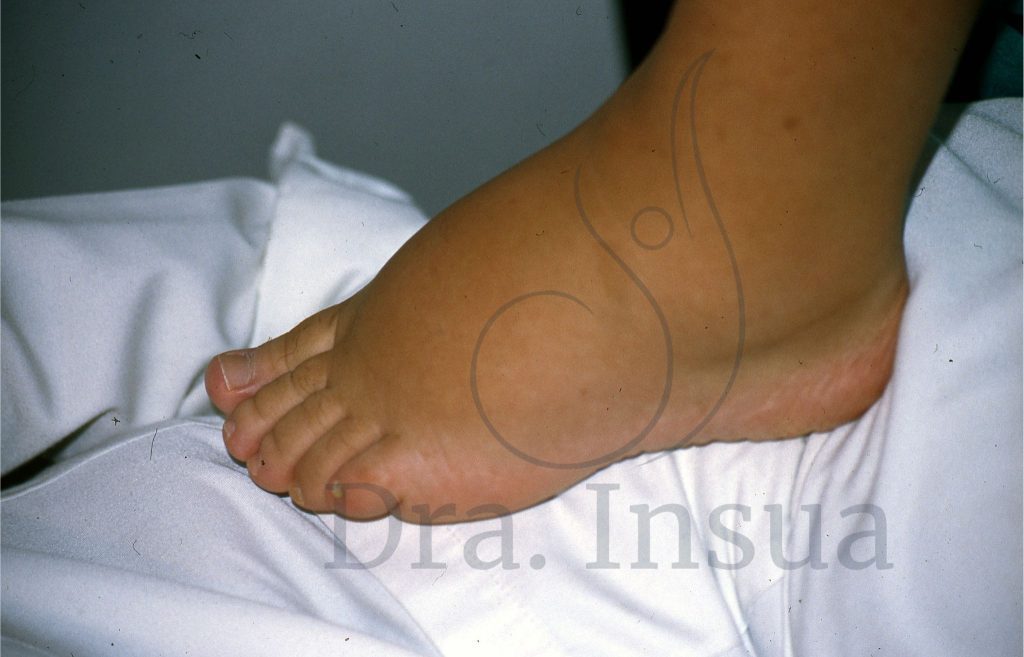 Linfedema primario en pie y dedos - Dra. Insua