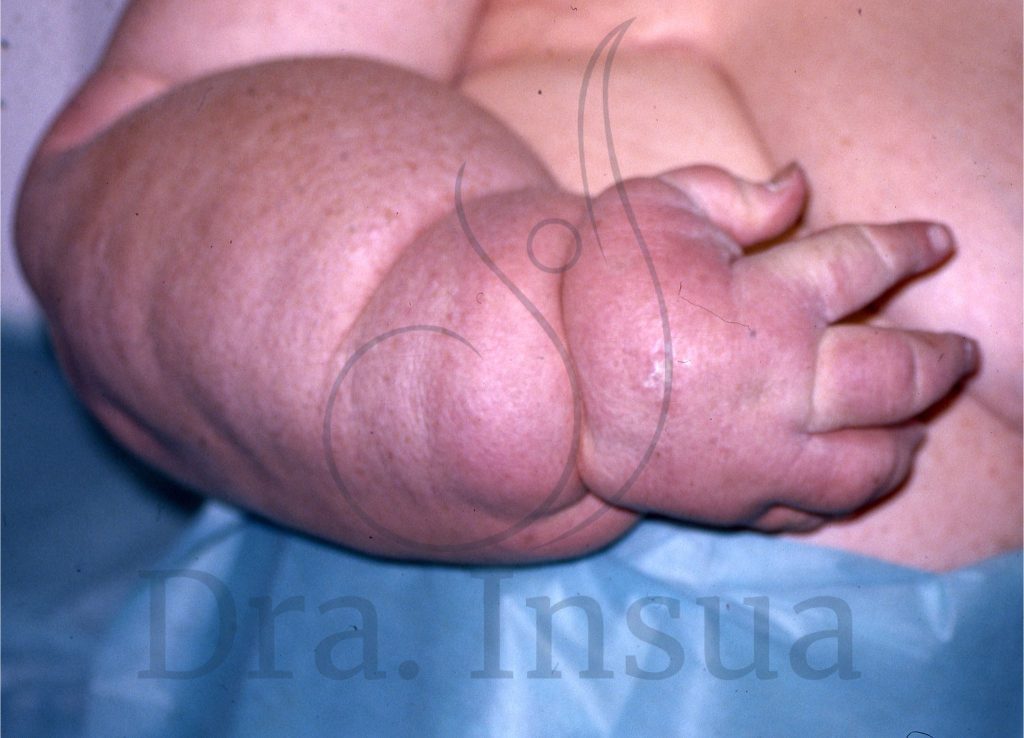 Linfedema secundario del miembro superior