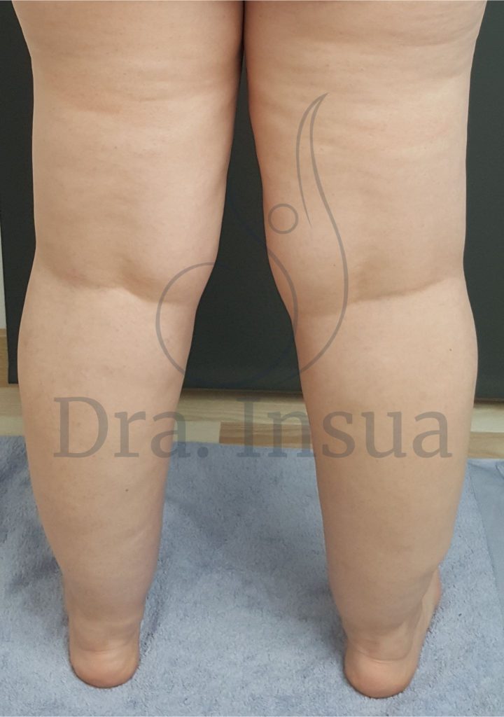 Lipedema asociado a obesidad y celulitis grado II - Dra. Insua