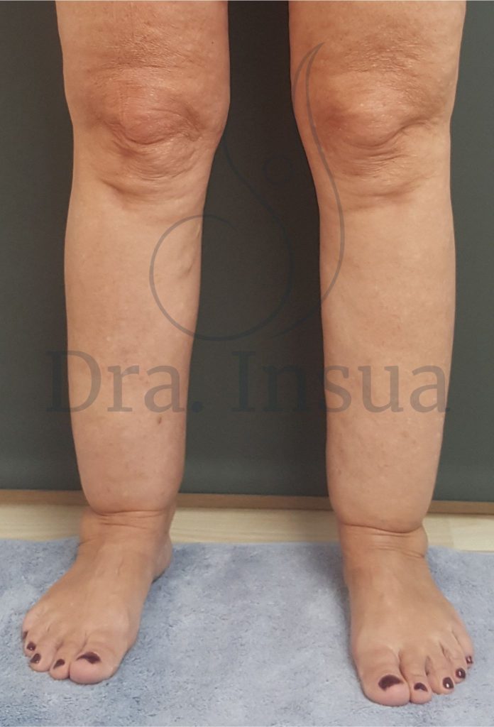 Lipedema en paciente con normopeso - Dra. Insua